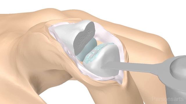 PIP Finger Joint Replacement Surgery смотреть онлайн