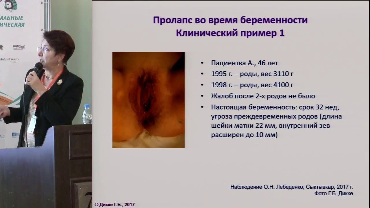 Задняя пластика влагалища, леваторопластика, пластика промежности. Контурная пластика