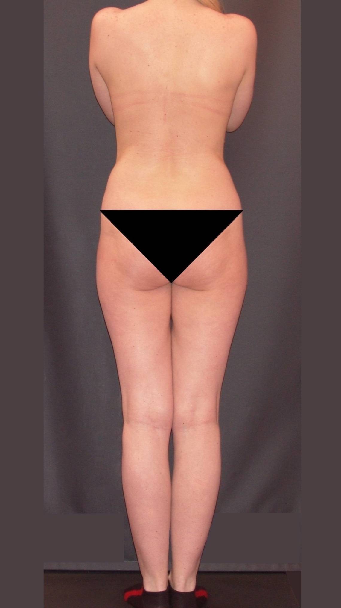 РУЧНАЯ ПЛАСТИКА ТЕЛА. КОРРЕКЦИЯ ФИГУРЫ. РЕЗУЛЬТАТ ДО И ПОСЛЕ. ВИДЕО 3.