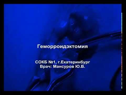 Геморроидэктомия с использованием технологии "ТЕРМОШОВ" 2