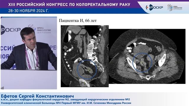 Комплексный подход к персонализированному лечению рака ободочной кишки
Ефетов Сергей Константинович