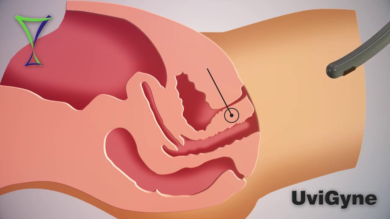 Радиоволновои RF лифтинг влагалища  эффективная процедура омоложения в гинекологии