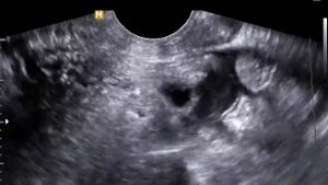 Перитубарная (паратубарная) киста