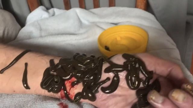 Хирудотерапия с пиявици. θεραπεία με ιατρικές βδέλλες. Третман со медицински пијавици. смотреть онлайн