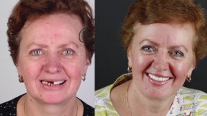 Отзыв о имплантации и протезировании в стоматологии Orlovsky Dental Center Правобережье/ г.Калуга