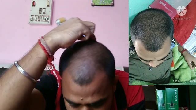 how to use neo hair lotion? neo hair lotion use with derma roller lHair care смотреть онлайн