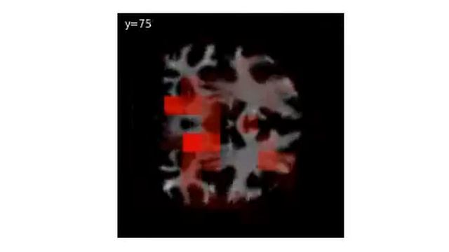 Occlusion Process for White Matter MRI with Resnet(y axis) смотреть онлайн