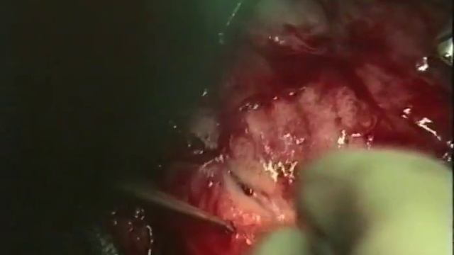 Малоинвазивная реваскуляция миокарда, проф. Б.В.Шабалкин ©Minimally invasive myocard revaskulyatsiy смотреть онлайн