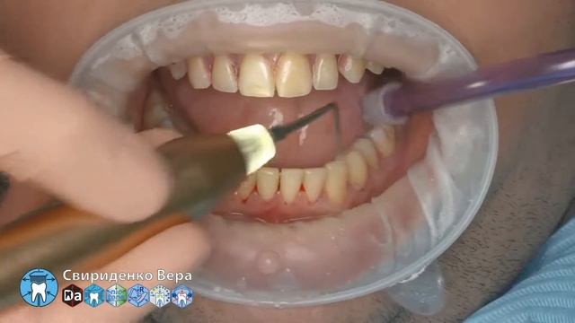 Professional oral hygiene -case 011 Acteon DTE Dentsply Coxo Floweis 3M KerrHawe (FHD multistream)