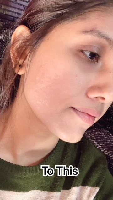 My skin transformation journey / Cystic acne , red scar #shorts #youtubeshorts #acne смотреть онлайн