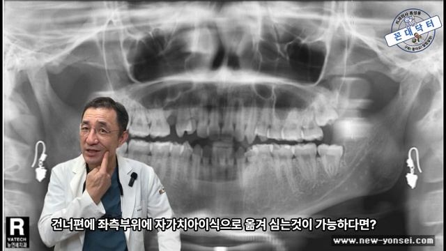 자가치아이식 치아교정으로 임플란트 갯수를 확 줄여주는 치과의사  #임플란트 #치아교정 #자가치아이식 #치과의사