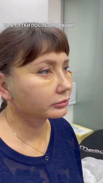 Фейслифтинг. Височный лифтинг. Нижняя блефаропластика. Доктор Козлов В.В.