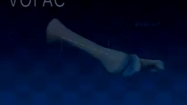 Hallux Valgus - Victorian Orthopaedic Foot & Ankle Clinic смотреть онлайн