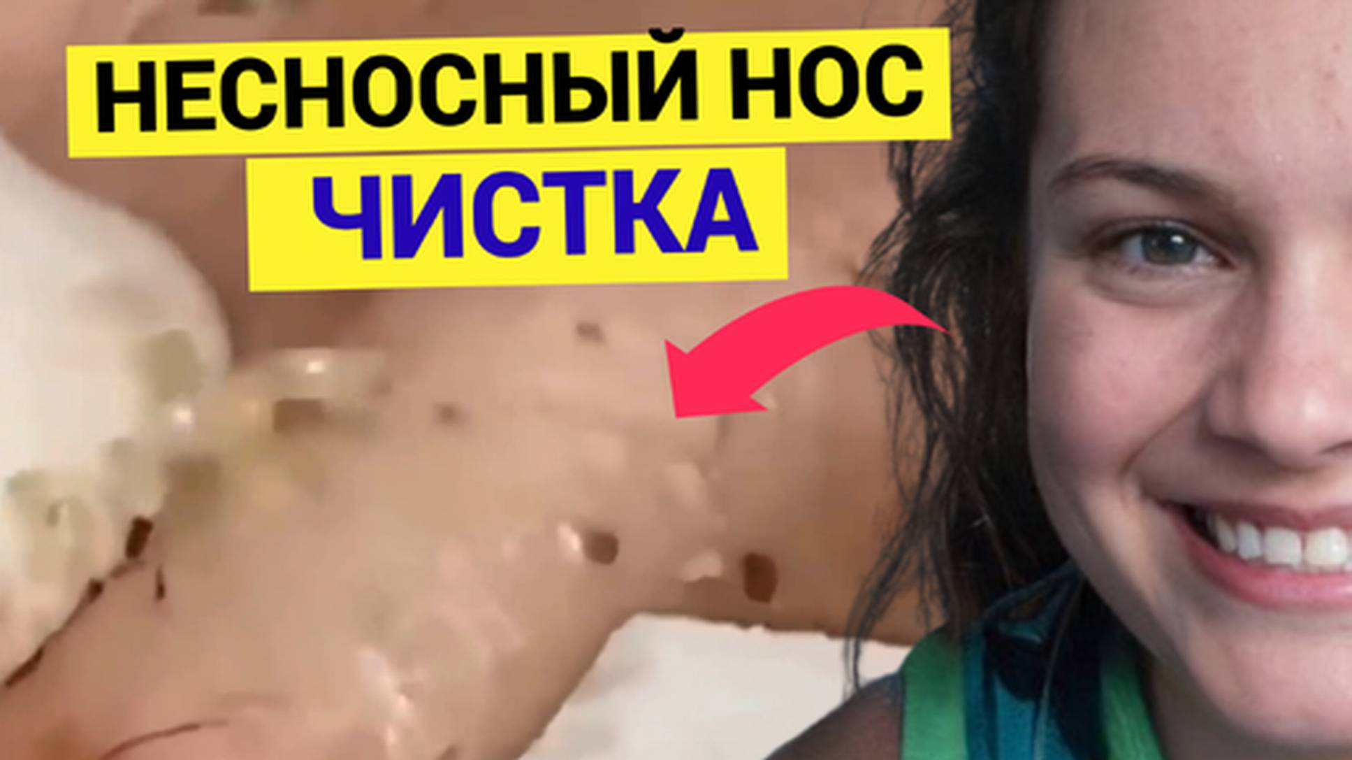 Очень запущенный Нос с НесНОСными Черными Точками разноцветными. Косметолог ВСПОТЕЛ пока закончил чи