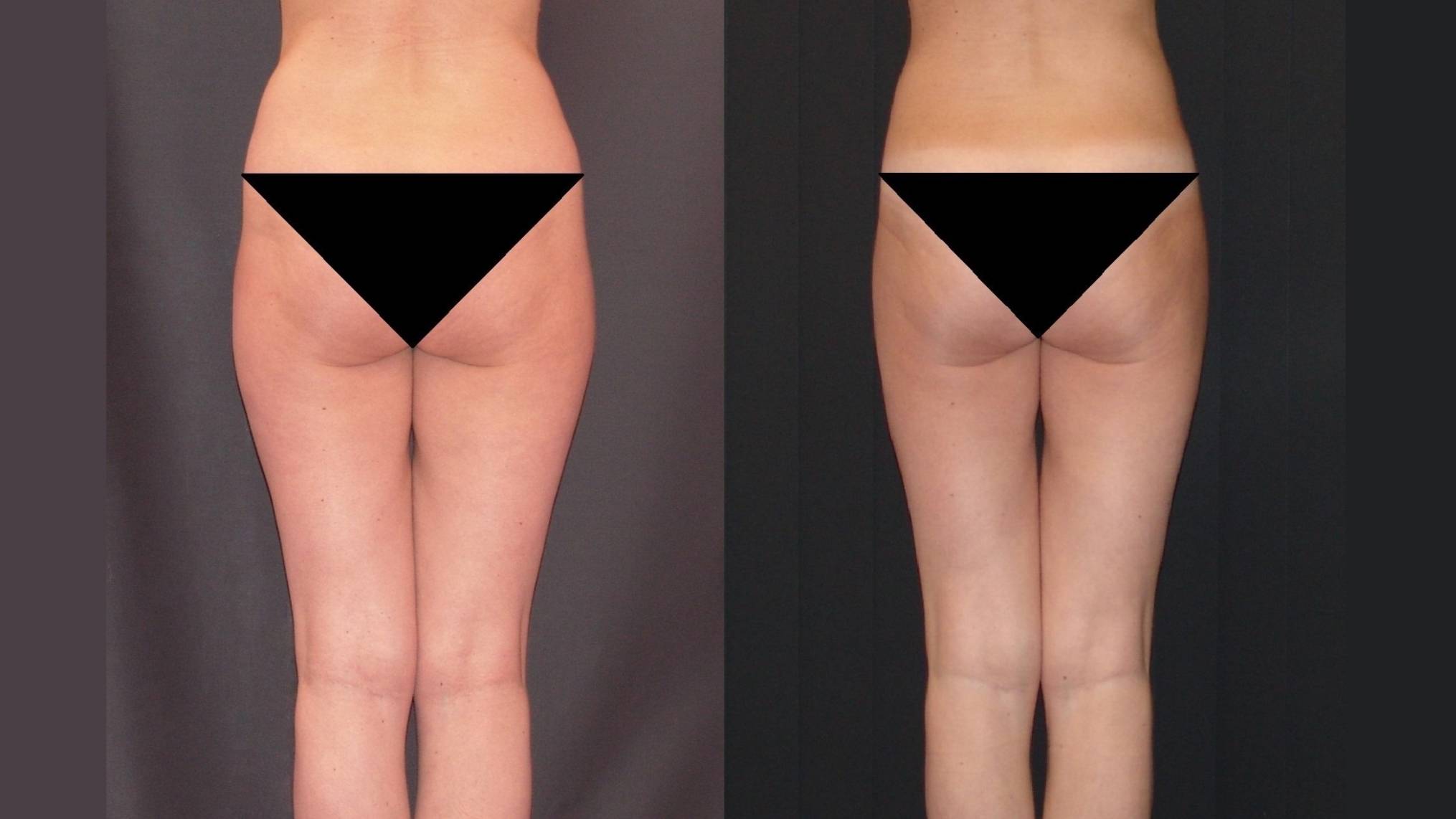 РУЧНАЯ ПЛАСТИКА ТЕЛА. КОРРЕКЦИЯ ФИГУРЫ. ПРИМЕР РАБОТЫ. ДО И ПОСЛЕ. ВИДЕО 3.