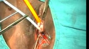 Urinary Incontinence in Women