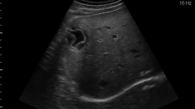 Cystic Echinococcus (CE3a) смотреть онлайн