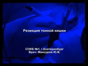 Резекция тонкой кишки