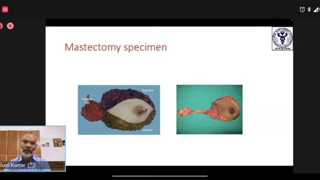 NBE- SURGICAL ONCOLOGY SPECIMENS DISCUSSION- DR. SUNIL KUMAR