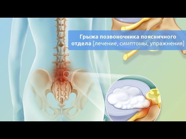Грыжа позвоночника | Как проходит первичная диагностика | Реабилитолог Павел Артемьев