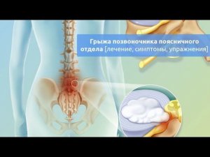 Грыжа позвоночника | Как проходит первичная диагностика | Реабилитолог Павел Артемьев