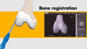Robotic Total Knee Replacement Animated Video