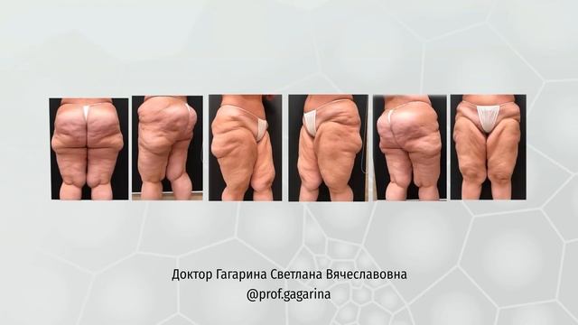 Липоскульптура VASER. Результаты работ хирургов с применением VASER-ассистированных технологий смотреть онлайн