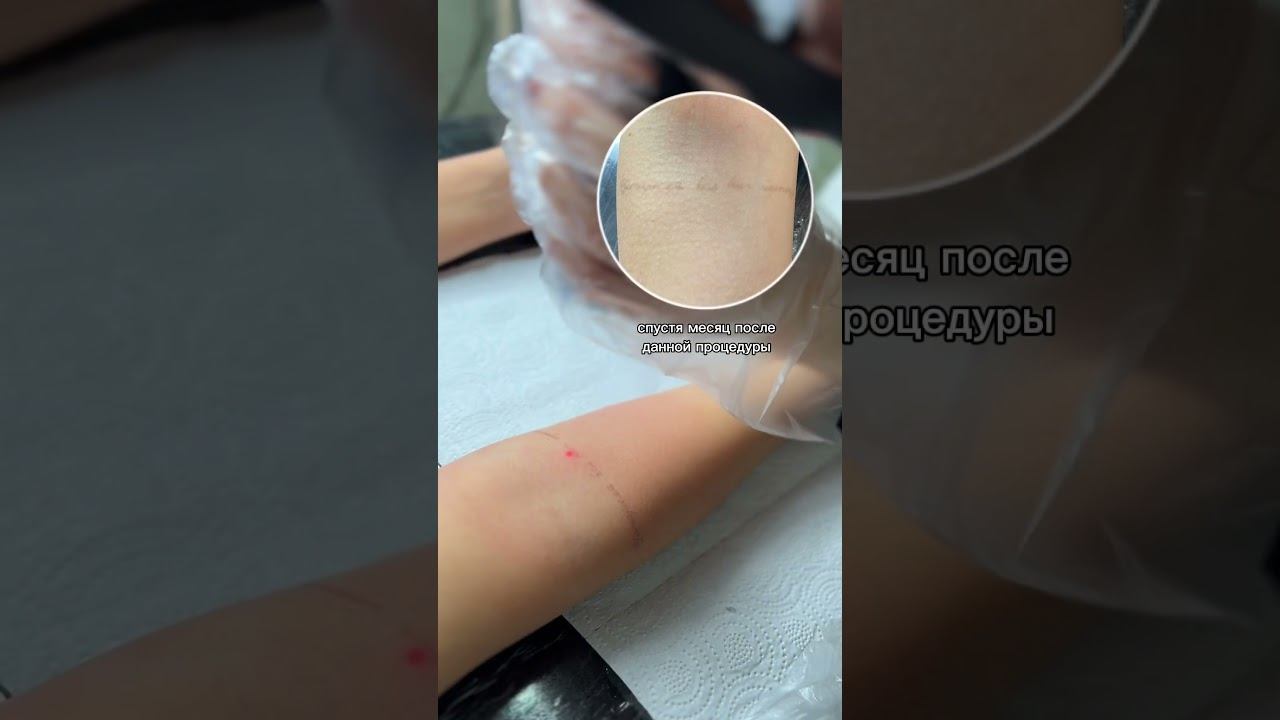 Совсем близки к полному удалению тату. Ещё больше о #лазерноеудалениетату — на нашем канале