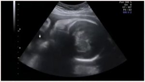 УЗИ 29 неделя беременности