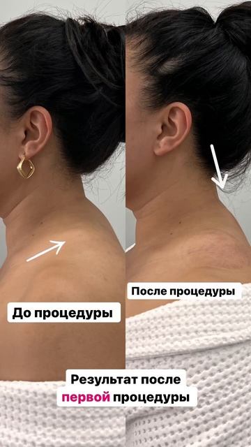 Результат с 1 процедуры.Холка #массажастана #остеопластика #скульптурныймассаж #убираемхолку #астан