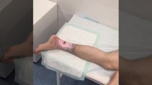 Лечение трофической язвы. Лазер  Minel black light ME2010