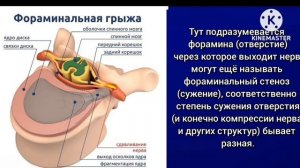 фораминальная грыжа фораминальный стеноз нужна ли операция ?