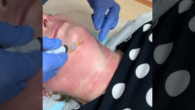 Векторный лифтинг 👩🏻⚕️