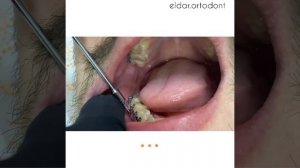 ВЫКРУЧИВАЕМ ВИНТЫ ? БОЛЬНО!