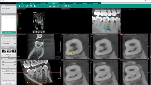 Vatech Ez3D i Mode ENDO sur le logiciel 3D Vatech