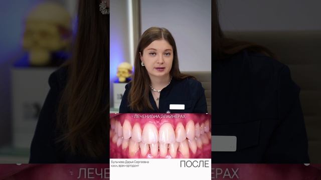 Лечение мезиального прикуса — Булычева Д.С.