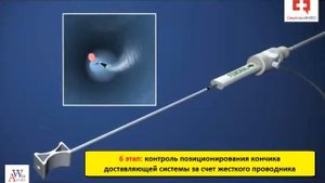 Имплантация временного кава фильтра и операция извлечения кава фильтра из полой вены