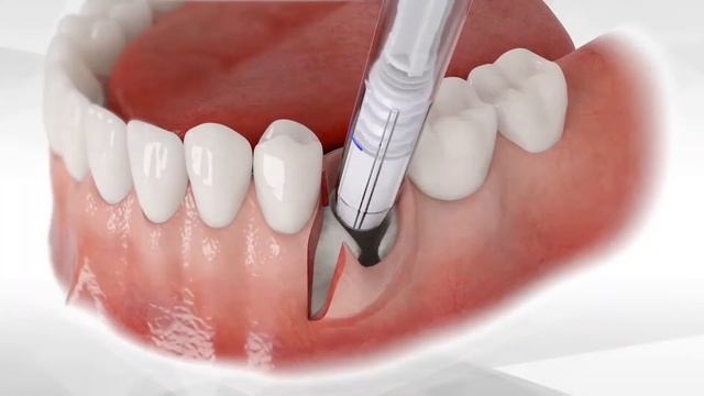 Graft Placement & Stabilization in less than One Minute смотреть онлайн
