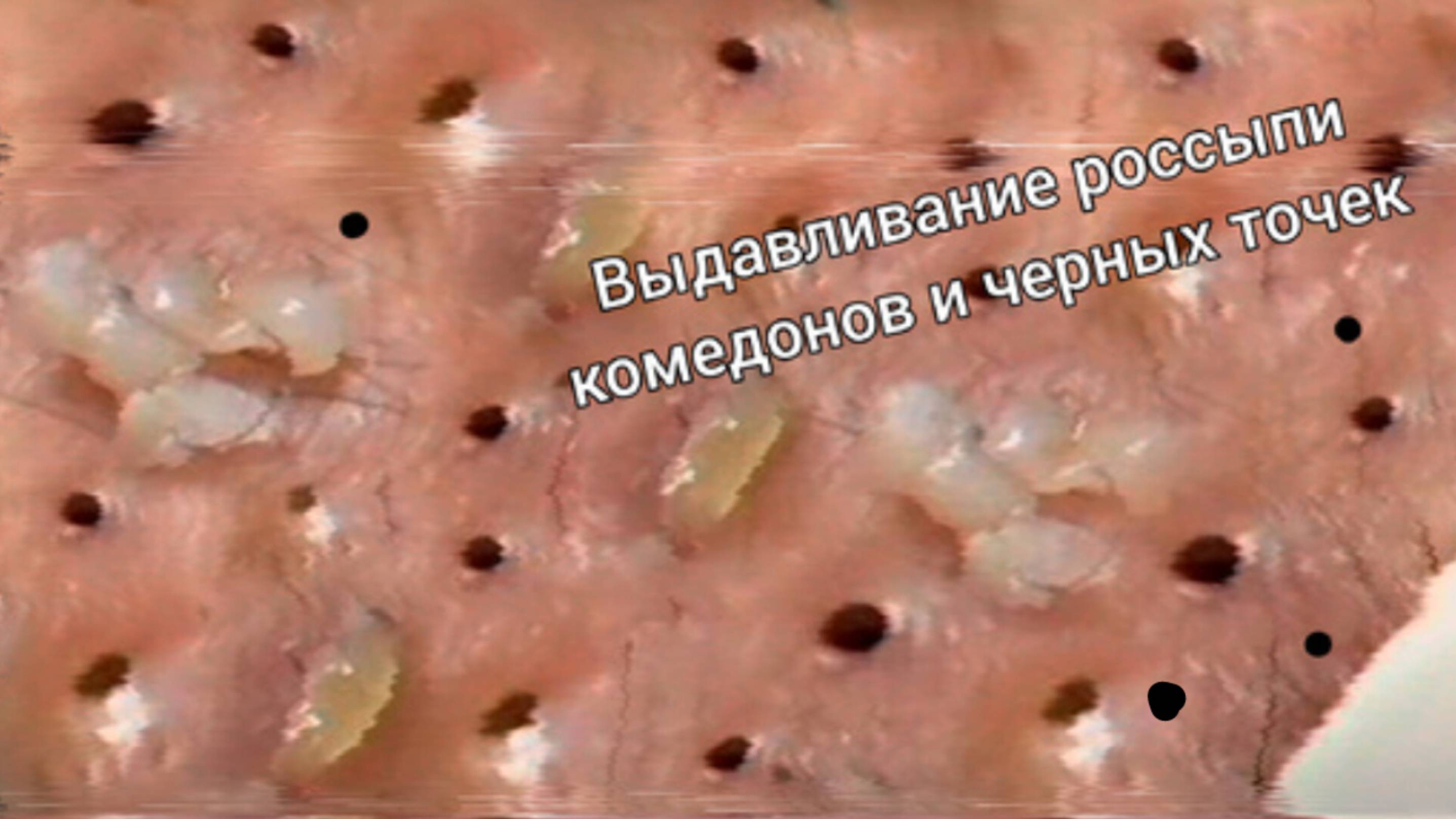 Всё лицо усыпано огромными КОМЕДОНАМИ и ЧЕРНЫМИ УГРЕВЫМИ ТОЧКАМИ. Механическая чистка от акне крупны