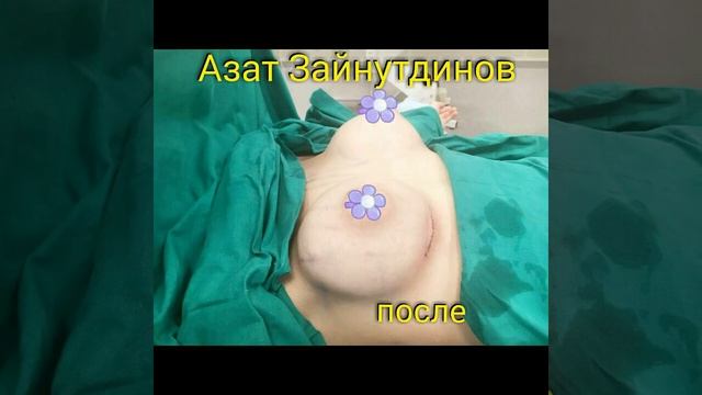 Маммопластика,  круглые импланты 245 мл #пластический хирургКазань#маммопластика#красиваягрудь#