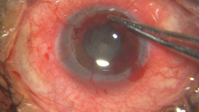 Therapeutic graft done for a non healing impending perforation Corneal ulcer-Principles outlined смотреть онлайн