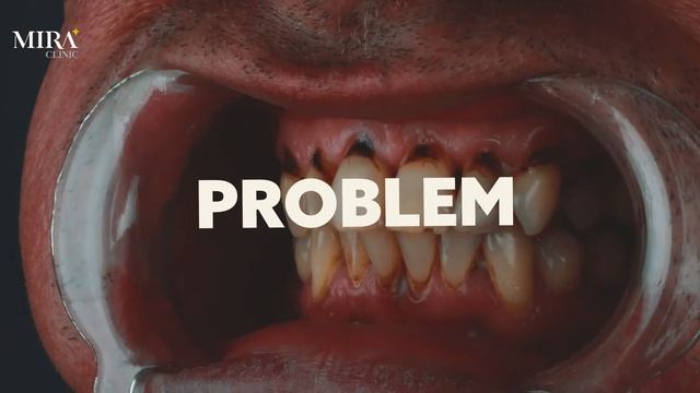 Hollywood smile in turkey 2023 -  CARL RICHARD LAKE from UK смотреть онлайн