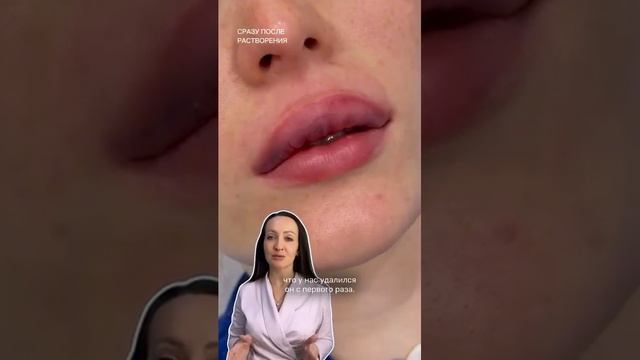 КЕЙС. ПЕРЕДЕЛАЛИ ГУБЫ ПОСЛЕ НЕУДАЧНОЙ КОРРЕКЦИИ
