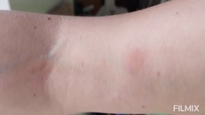 Укусила оса. Что делать?