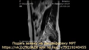 На расшифровке МРТ малого таза у женщины обнаружена киста левого яичника