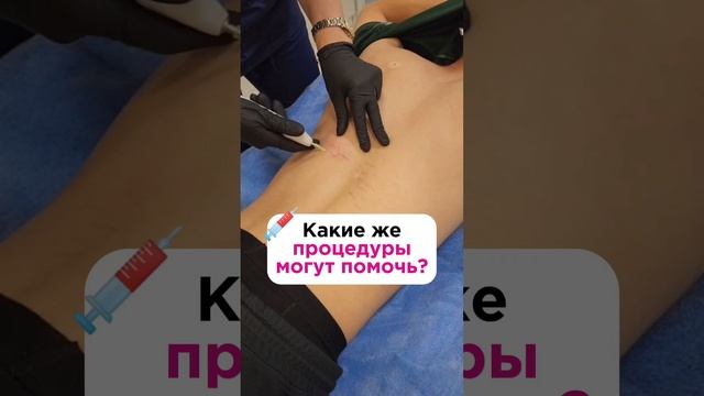 Что делать, если появились растяжки? смотреть онлайн