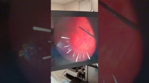 Операция на сетчатке: взгляд изнутри! Важное видео от нашего хирурга Унгурьянова О.В.