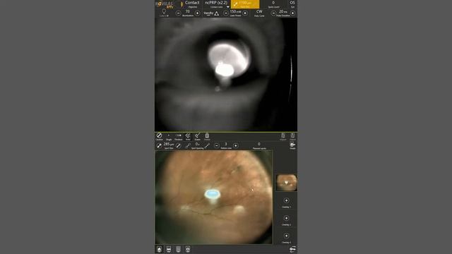 Laser retinopexy: Non-contact navigated laser treatment of a retinal tear with Navilas® 577s смотреть онлайн
