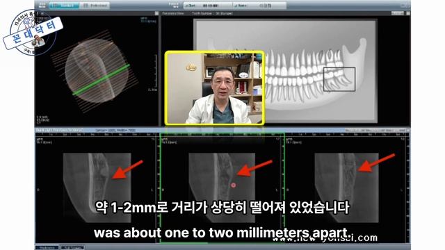 완전매복 사랑니 수술발치 과정 #사랑니발치 Surgical extraction of the full impacted wisdom tooth