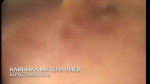 Гистероскопия, спайки в матке, синдром Ашермана II